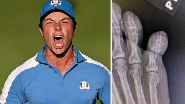 Viktor Hovland shows off his broken toe.
