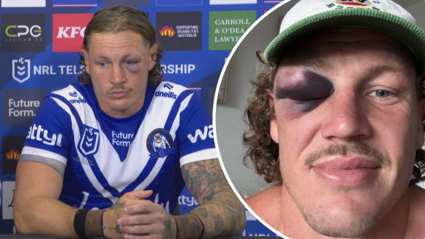 Kurt Mann shows off his black eye after Bulldogs’ victory over Dragons.